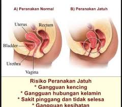 Ketahui tanda rahim tidak sihat dan peranakkan jatuh dengan segera menemui doktor pakar puan. Lagi Banyak Hamil Bersalin Lagi Tinggi Peluang Peranakan Jatuh Pakar O G Dedahkan 6 Lagi Punca Rawatan Pa Ma