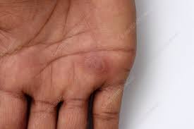 Image result for Fixed Drug Eruption