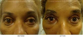 With bell's palsy, your eyelid may not close properly and your smile may seem uneven. Facial Nerve Paralysis Bell S Palsy Before And After Photo Gallery