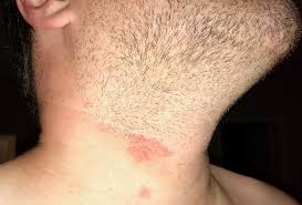 Herpes is caused by two different viruses: Print Version Consultant 360