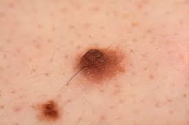 L'exérèse chirurgicale d'un naevus est le prolongement logique de l'activité de dépistage et de diagnostic des lésions cutanées à. Grains De Beaute Pourquoi Les Faire Surveiller Quand Sont Ils Dangereux Et Quand Faut Il Les Enlever