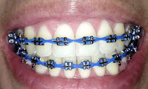 Popista Braces Colors Metal Braces Cute Braces Colors