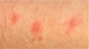 Image result for Cimex lectularius bites