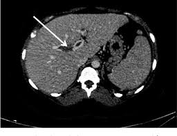 Pdf Clinique Hrombose Portale Associee A Une Infection Igue A Cytomegalovirus Ortal Vein Thrombosis Associated With An Acute Ytomegalovirus Infection Semantic Scholar