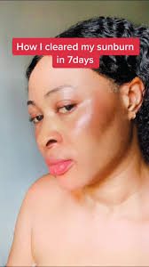 I cleared my sunburn permanently in just 7days