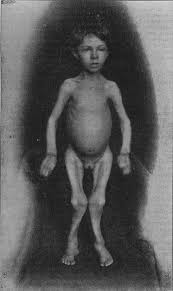 Image result for Rickets