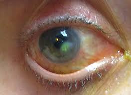 How to flip your eyelid. The Diagnosis Was A Flop
