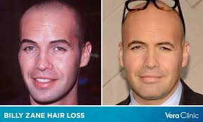 Billy Zane Hair Loss: Exploring the Transformation of a Hollywood Star