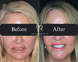 ➡️ Swipe through this full transformation! ✨ This patient received a  complete set of custom crowns by Dr. Stan at Smile Boutique. From worn and  uneven to bright, balanced, and beautiful, this