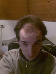 Haarverdichtung oberkopf nie wieder lichtes haar beauty. Frisur Mit Geheimratsecken Und Kahler Stelle Am Hinterkopf Haare Tipps Styling