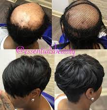 Talented Alopecia Hairstyles Black Women Hair Loss Hair Growth Methods