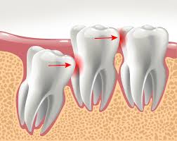 However, when an impacted wisdom tooth becomes infected, damages other teeth or causes other dental problems, you may experience some of these signs or symptoms: How To Know If You Have An Impacted Wisdom Tooth Dentist Richmond Hill Dentist Near Me Richmond Hill Dental Clinic Richmond Hill