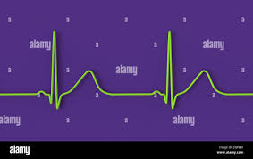 Image result for QT Interval
