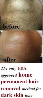 The Only Fda Approved Permanent Hair Removal Methods Are Electrolysis And Laser Th Permanent Facial Hair Removal Facial Hair Removal Permanent Hair Removal Diy