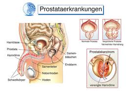 Dafür übernehmen die gesetzlichen krankenkassen die kosten. Die Prostata Untersuchung Inkontinenz Information De