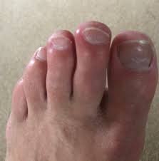 Image result for Chilblains