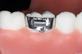 Maybe you would like to learn more about one of these? Fixed Orthodontic Appliances Pptx Dr Hakam Muhadharaty