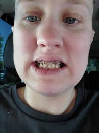 Spark clear aligner journey and progress update