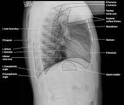 Many clinical conditions can be evaluated by this simple radiology test. Normal Chest X Ray Litfl Medical Blog Labelled Radiology