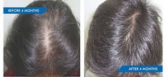 Hair loss is a common symptom of both thyroid disorders. Hair Loss From Thyroid Imbalance Hairlossindia