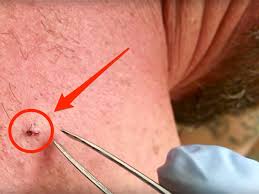 Shaving tips to prevent ingrown hairs. Video Pulling Out A 6 Year Old Ingrown Hair