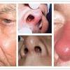 Nasal vestibulitis refers to bacterial infection in the nasal vestibule (front part of the nasal cavity). Https Encrypted Tbn0 Gstatic Com Images Q Tbn And9gcs 53cepfqovaaytepgf3hux5lohglenattdaohbpl85izhijae Usqp Cau