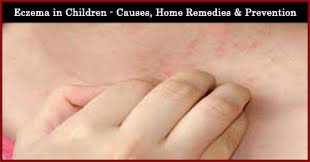 Both of which will prevent as well as treat eczema in children. Eczema In Children India Parenting
