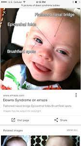 Epicanthal folds appear most frequently in persons with down syndrome and some other to the untrained eye, an epicanthal fold may look similar to the eye fold found in peoples of asian origin, but the normal. Pin By Lindsey Jones On Crafts Down Syndrome Down Syndrome Kids Down Syndrome Baby