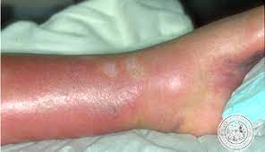 Das Erysipel Wundrose Lymphodem Vasoprime