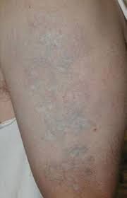 Keloid scars can be removed! Tattoo Removal Long Island Laser Tattoo Bergen County Nj Queens
