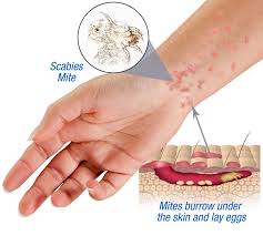 Image result for scabies on humans