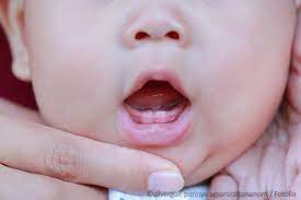 Sowohl die milchzähne als auch die bleibenden zähne sind schon vor der geburt des kindes im kiefer angelegt. Der Erste Zahn Beim Baby
