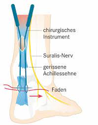 Daneben können nach einem achillessehnenriss folgende symptome auftreten ein achillessehnenriss (achillessehnenruptur) äussert sich durch verschiedene, teils typische symptome. Achillessehnenriss Anzeichen Und Behandlung Apotheken Umschau