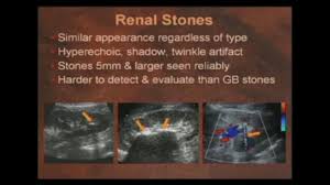 Pin By Dr Abuaiad On Renal Renal Stones Renal Twinkle Twinkle
