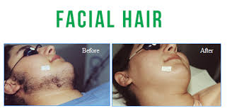 After working for 4 years in the beauty industry she achieved her dream, to open a beauty salon. Kingston Laser Laser Laser Hair Removal