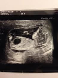Anyone Have Similar Experience Enlarged Bladder At 12 Week Scan Babycentre
