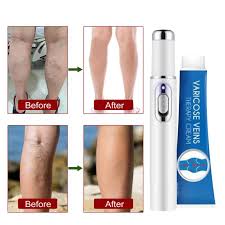 Natural De Las Venas Varicosas Crema Para Las Varices Pomada Tratamiento Natural Para El Alivio De La Flebitis Granulomatous Pierna Untando Crema Remedios Oferta Herramientas Para El Cuidado De La Piel