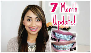 Braces Update Before And After Power Chain Repositioning Etc Braces Body Youtube