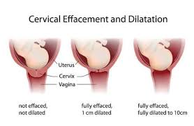 But if a mom is 4 to 5 centimeters, and is. Dilation Of The Cervix What You Need To Know Bellybelly
