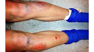 Rug Burn: Scar, On Back, Picture, Infected, And More