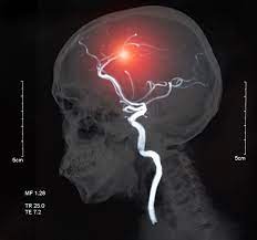 Inlaturarea acestor factori de risc va obliga la. Atacul Vascular Cerebral Simptome Si Tratament Centrokinetic