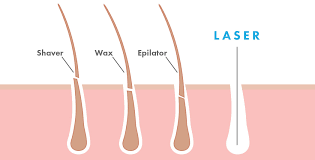 Burns, permanent changes to your skin color. Laser Hair Removal Birmingham Vivo Clinic