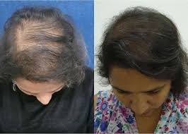 Finally, any internet search on alternative treatments for hair loss will reveal a variety of options you can try. Aq Advanced Hair Complex London Dr Sw Clinics