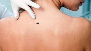 Ces boutons sous la peau, aussi appelés comédons fermés, ne peuvent s'extraire de l'épiderme par simple pression comme on le ferait pour un comédon ouvert, autrement dit pour éliminer les points noirs. Avoir Des Boutons Dans Le Dos N Est Pas Agreable Heureusement Il Existe Des Solutions Simples Et Naturelles Pour Back Acne Treatment Chest Acne Painful Acne