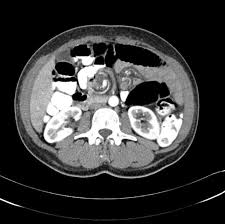 Image result for Midgut Volvulus
