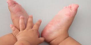 They often peel, leaving an ulcer, which is a sore with a reddish base. Hand Foot And Mouth Disease Symptoms Causes And Treatments