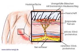 Hierbei siedeln sich die erreger überall im menschlichen körper an. Doktorweigl Erklart Gurtelrose Herpes Zoster Eine Unangenehme Folge Der Windpocken