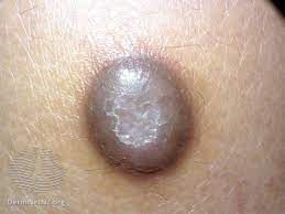How To Tell A Lump From A Lymph Node