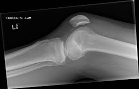 Disorder of subchondral bone leading to cartilage lesions. Medial Femoral Condyle Avulsion Fracture Radiology Case Radiopaedia Org