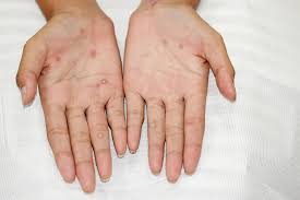 Image result for syphilis symptoms